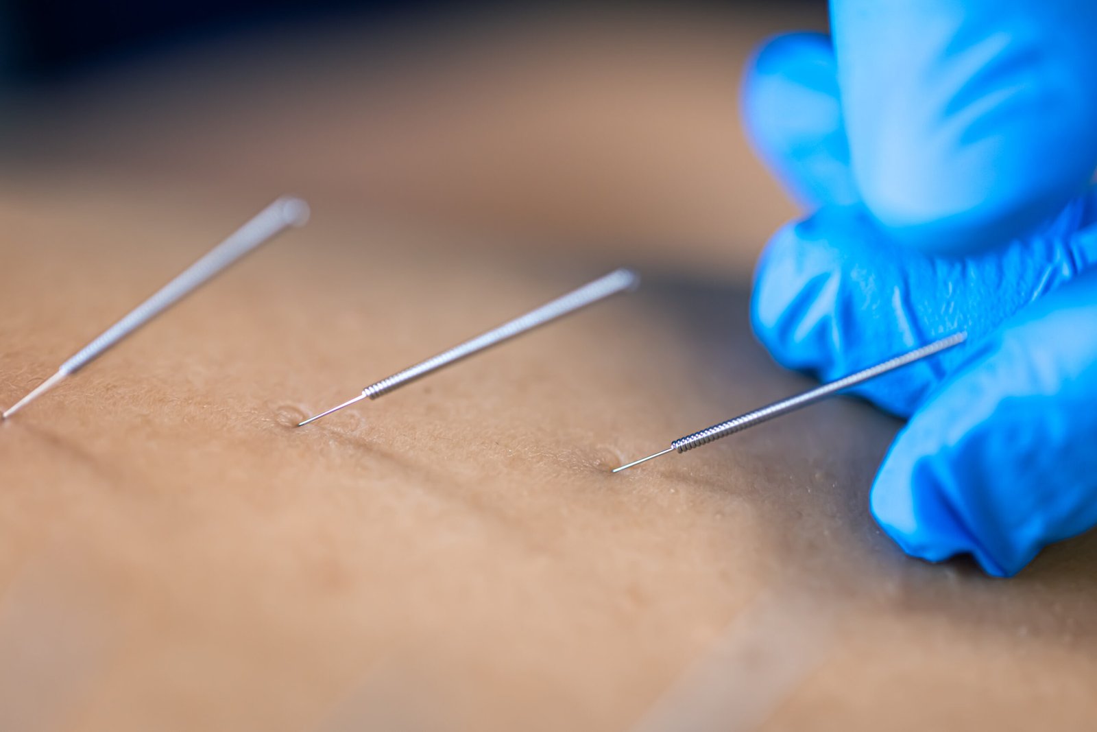 Close up of a needle and hands of physiotherapist doing a dry needling in a physiotherapy center.